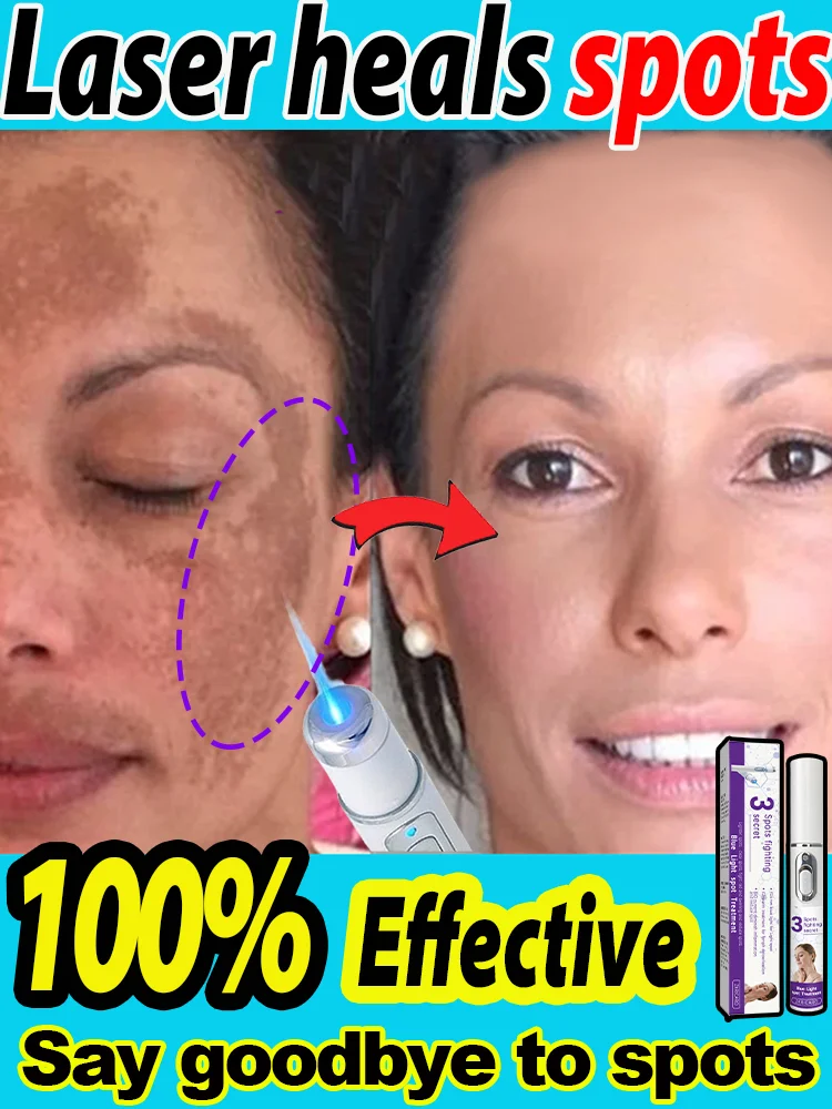 Terapia con láser para curar las manchas
