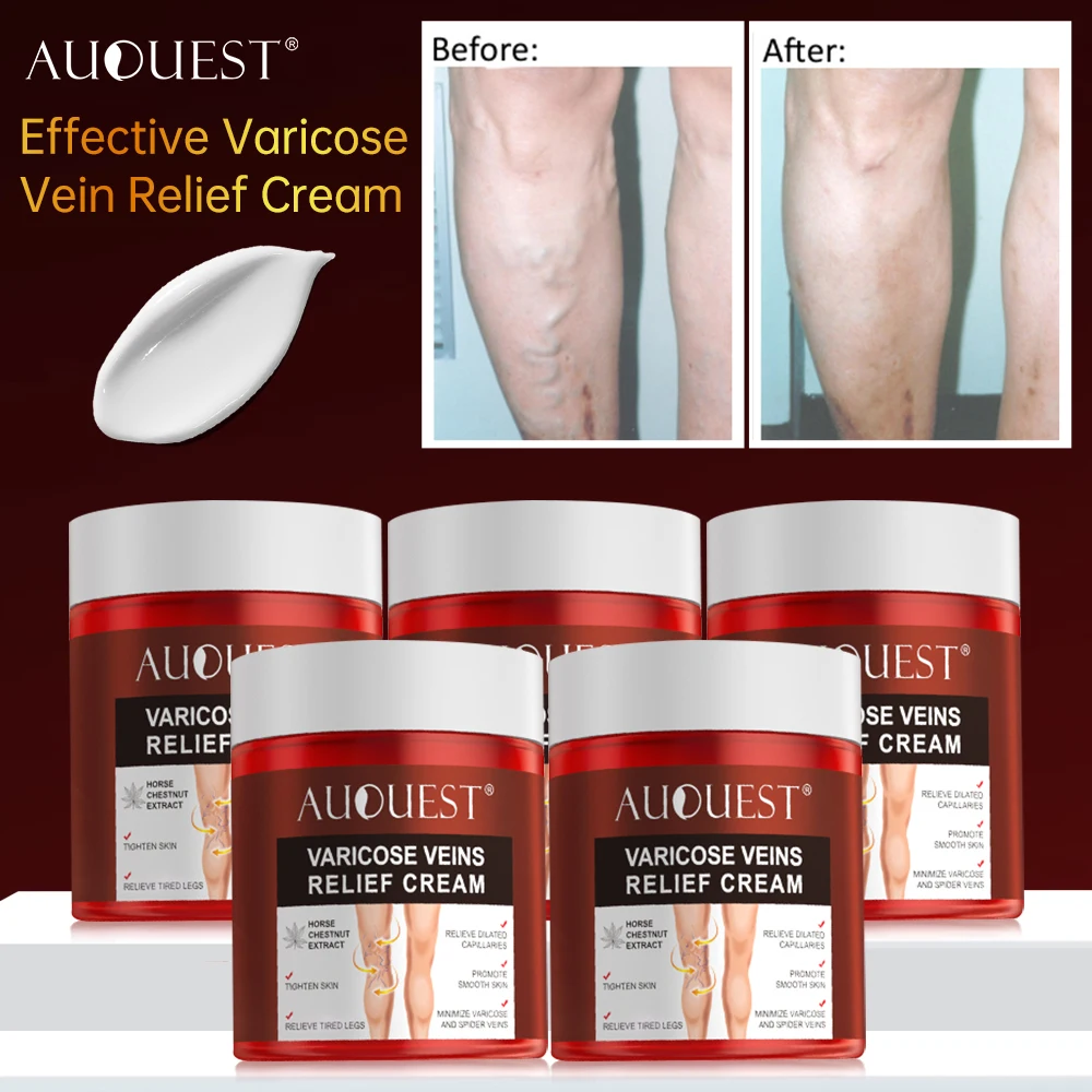 Effective Varicose Vein Relief Cream Removal Vasculitis Phlebitis Ointment Foot Legs Dilated Capillaries Treatment Body Care