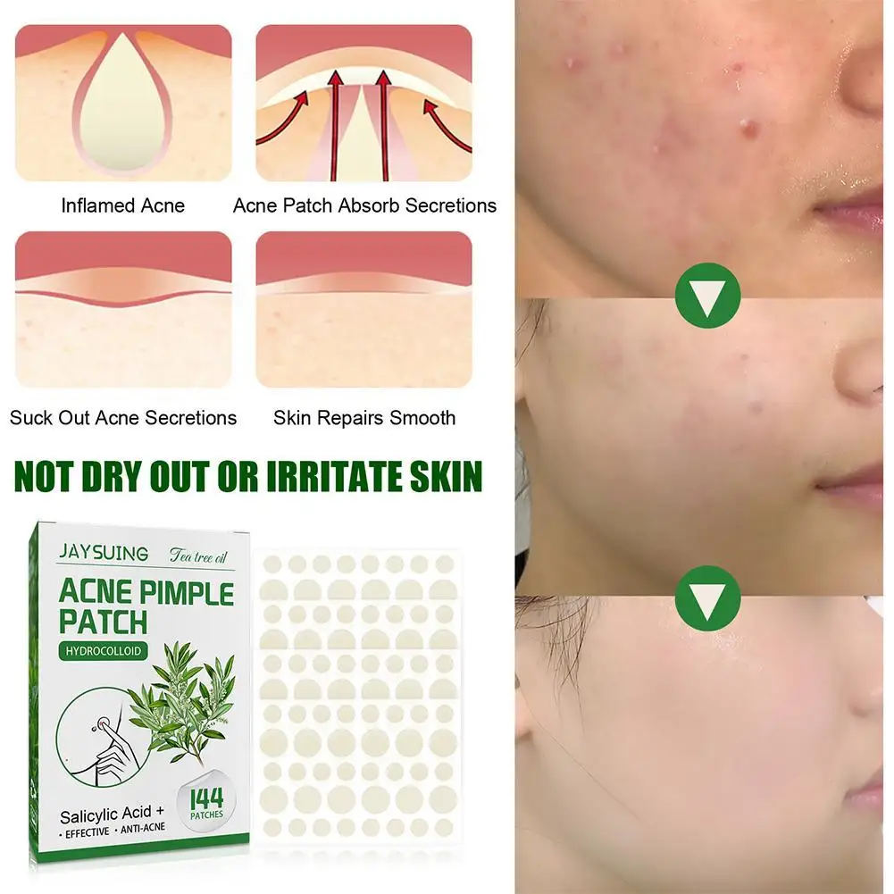 1/2/5packs Tea Tree Essential Oil Acne Patch Acne Pimple Blemish Spot Treatment Remover Tool Invisible Breathable Face Skin Care