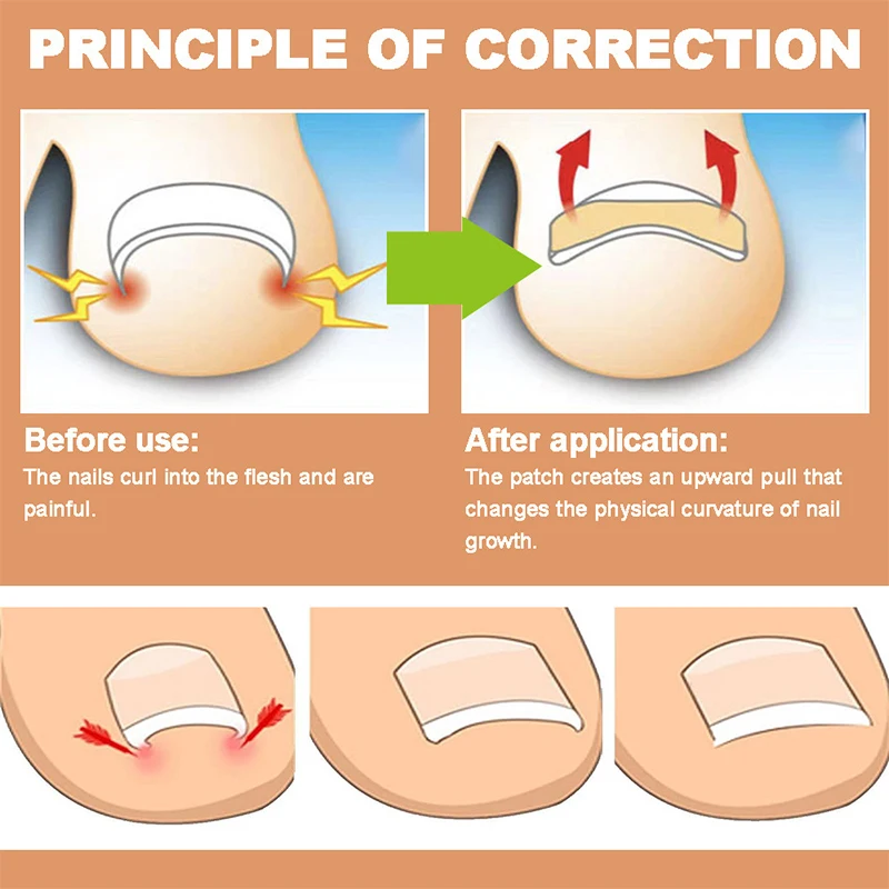 ملصقات تصحيح الأظافر الناشئة ، رقع مصحح أظافر القدم ، علاج البارونيشيا ، أداة العناية بالأظافر ، 60: 50