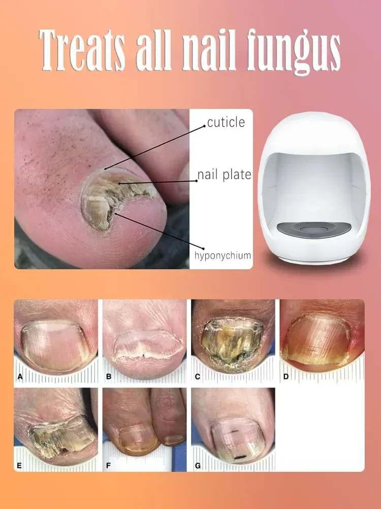 Onicomicosis láser de hongos para uñas, reparación rápida de uñas