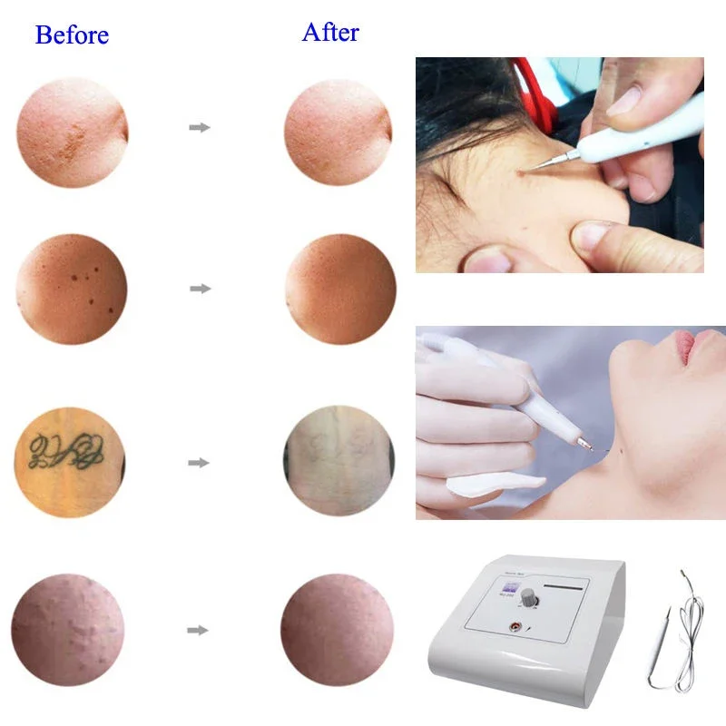 

lll Hot Sale Remover Beauty Instrument Professional Skin Label Remover