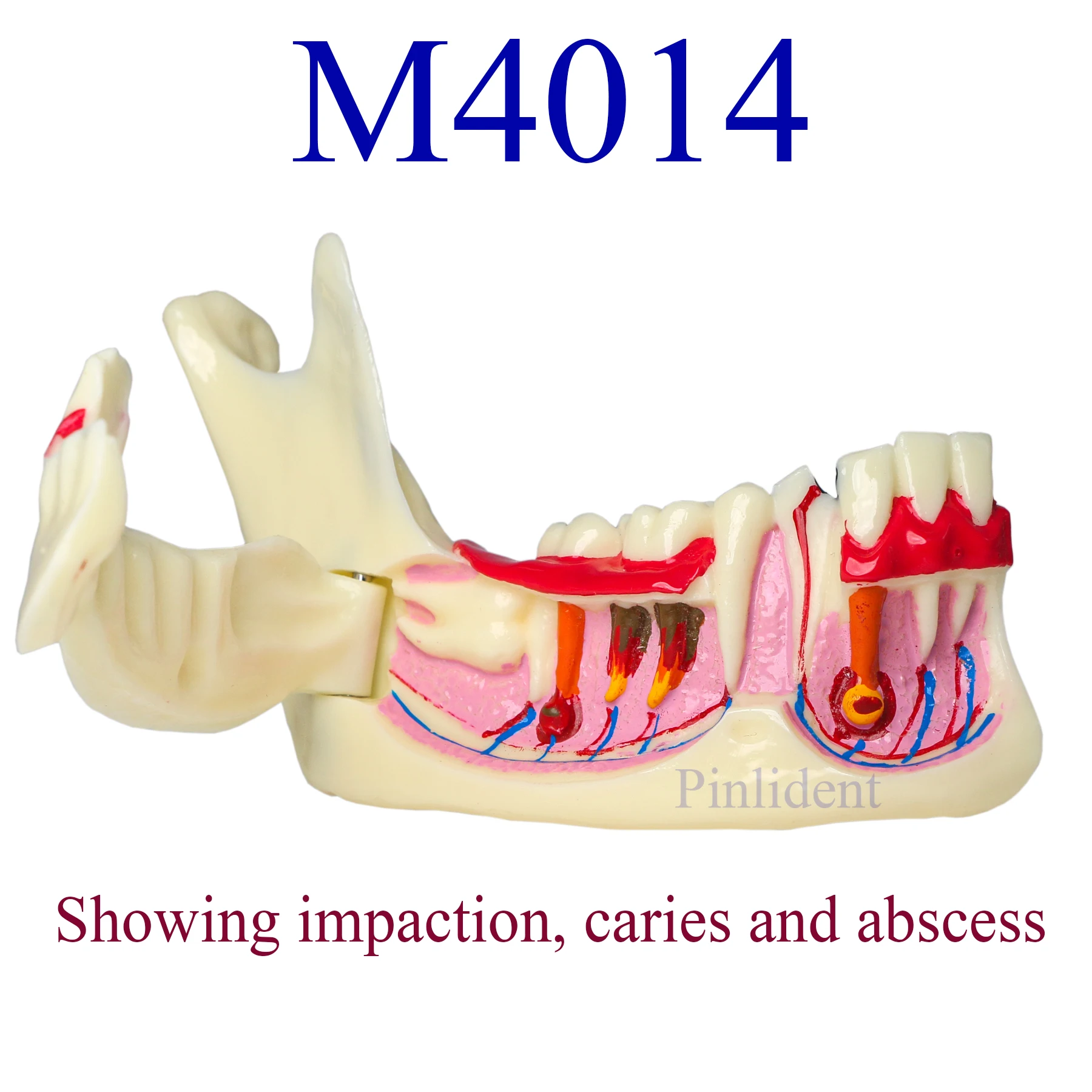 Dental Endodontic Model Gingival Anatomy Mandibular Tissue Model Anatomical Model Teaching Research Demonstration Caries M4014