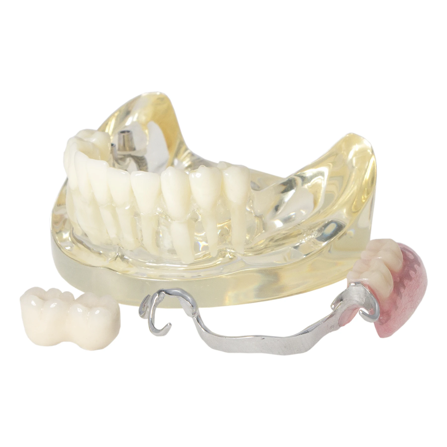 

Dental Implant and Restpration Typodont Teeth Model with Partial Denture Steel Bracket M6022