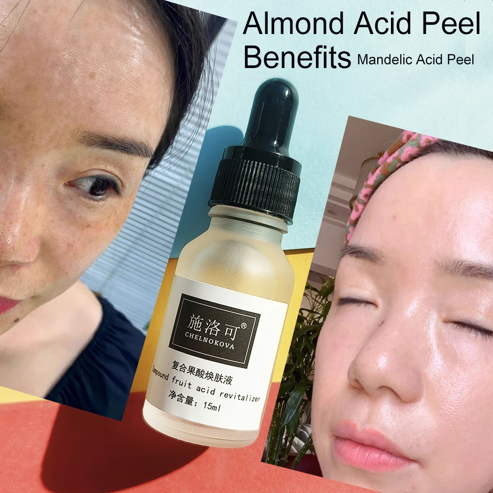 Sensitive Skin peel peeling peels Almond Acid 18% 20% Mandelic Acid Skincare Routine 15ml for Unhealthy skin Skin Care