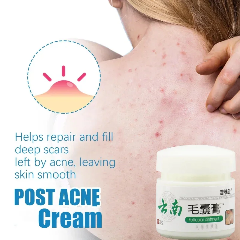 Body Acne Removal Cream Treatment Face Butt Back Acne Marks Smooth Repair Chicken Skin Cream Moisturizing Whitening Skin Care