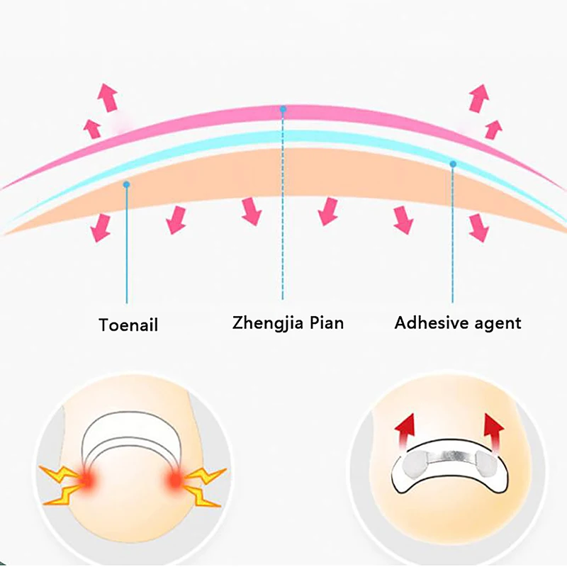 Ingrown Corrector unha para pedicure, Incorporar Toe Nail Treatment, Correção de unha engrown profissional, Pé Care Tool