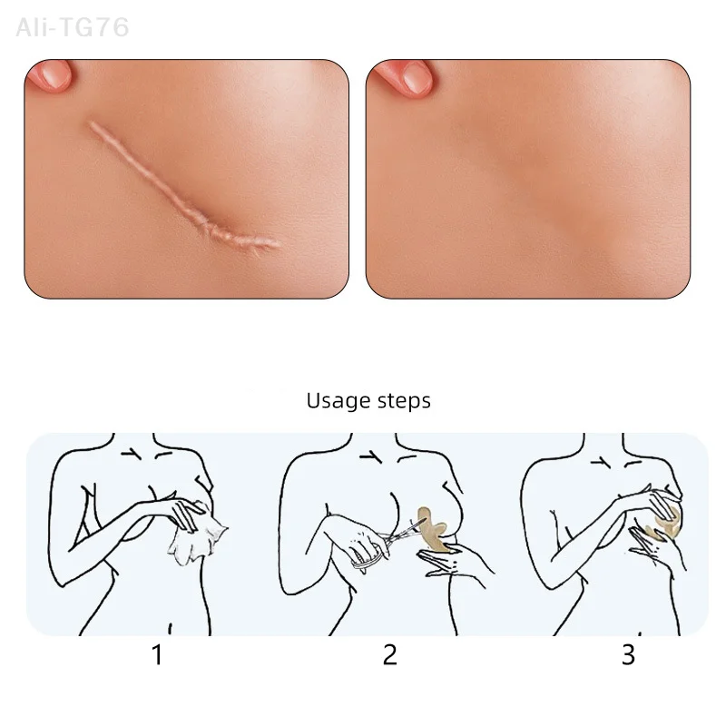 Reusable Silicon Gel Invisible Stickers, Circular, Arc, Chest, Concealer, Scar Repair Patch, Tattoo Flaw, Conceal Tape