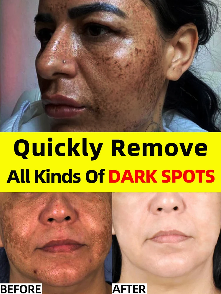 Age Dark Sun Spot Freckles Chloasma Clear