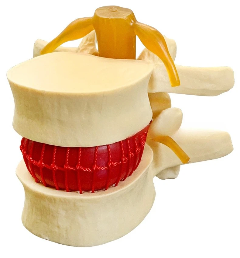 

Demonstration model of human lumbar intervertebral disc disease, lumbar spine model, spine model
