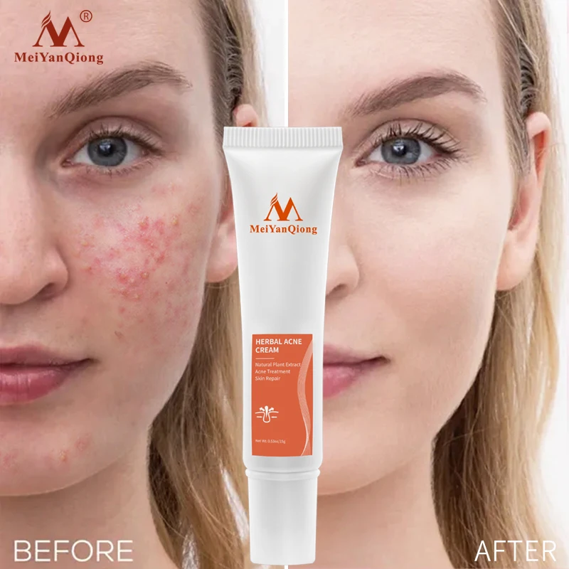 

Acne Cream Acne Removal Eliminate Acne Marks Repair Damaged Skin Moisturizing Nourishing Whitening Skin Rejuvenating Face Care