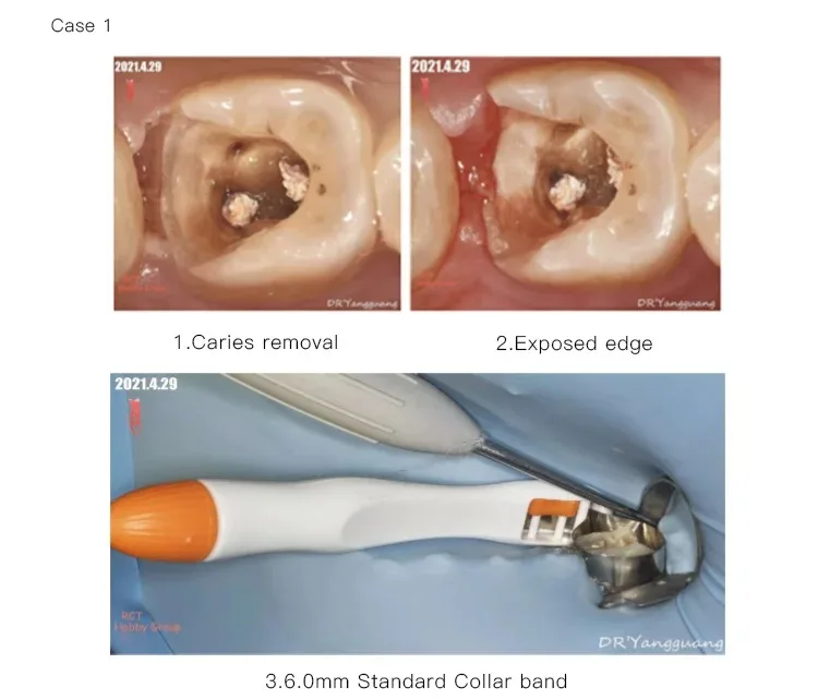 50PCS Dental Sectional Profect Matrix Band Halten Einstellen Vor Geformt 4,5/6,0 MM Ring System Werkzeug für zähne Füllung Materias – Detail 6