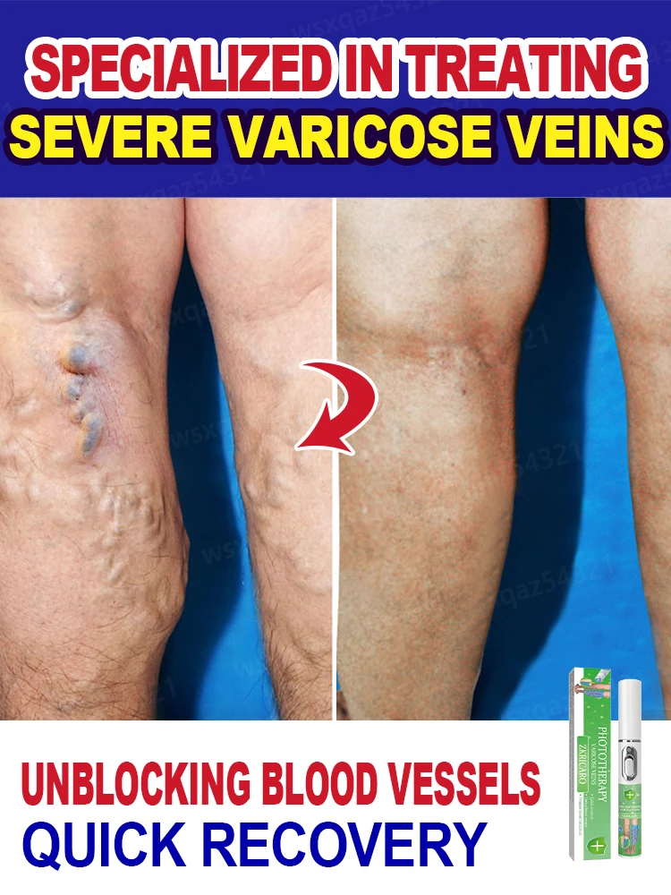 Intravenous laser treatment can improve moderate varicose veins, effectively unclog and permanently eliminate varicose veins