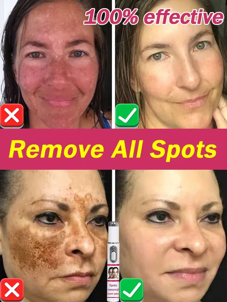 Laser facial spot removal is fast and effective