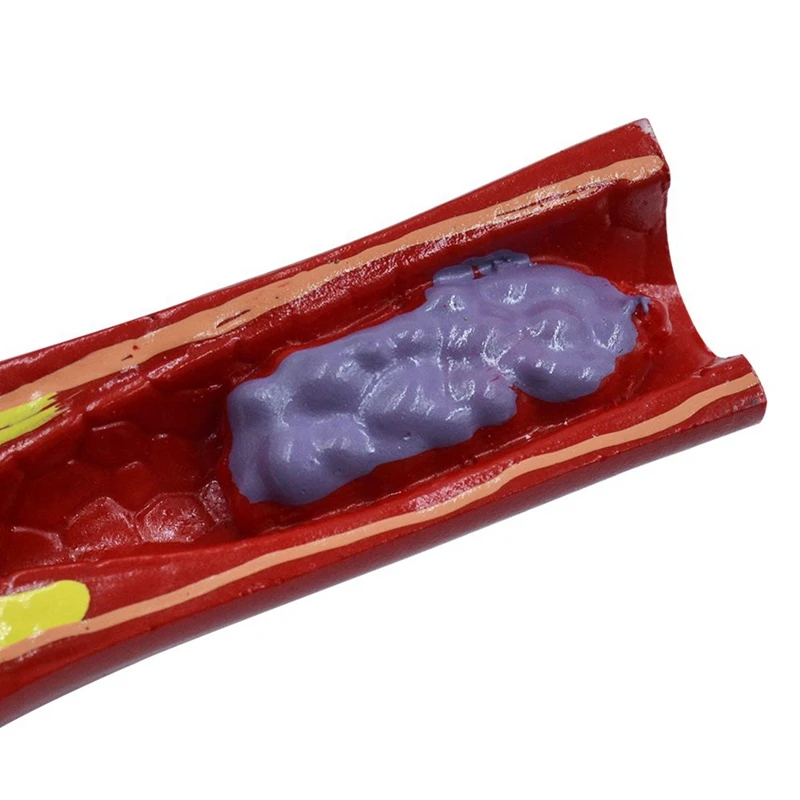 Human Atherosclerosis Cardiovascular Model Vascular Anatomy Model Branch Atherosclerosis Teaching Supplies