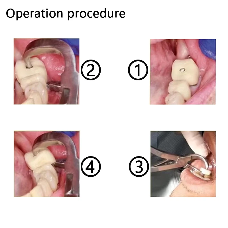 1 szt. Szczypce do usuwania korona dentystyczna ze stali nierdzewnej narzędzia do usuwania koron chirurgia stomatologiczna