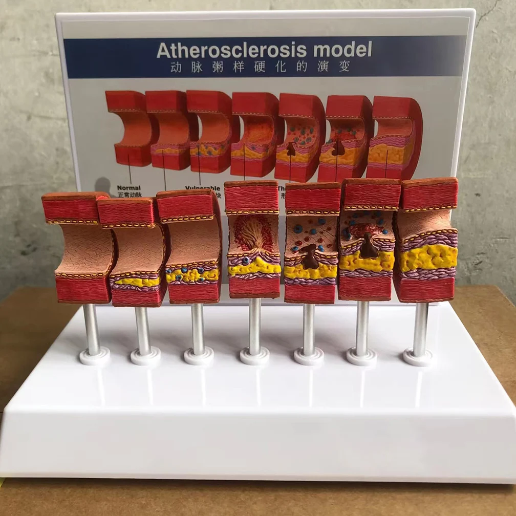 

7 Stages In 1 Arterial Vessel Atherosclerosis Model Middle-Aged And Elderly Blood Vessel Structure Anatomia Models Medical Set