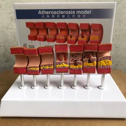 7 Stages In 1 Arterial Vessel Atherosclerosis Model Middle-Aged And Elderly Blood Vessel Structure Anatomia Models Medical Set