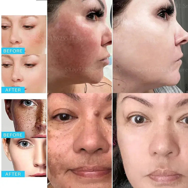 Niacinamide Skin Whitening Day Cream Remove Melasma Acne Spot Pigment Melanin Dark Spots Pigmentation Whitening Cream