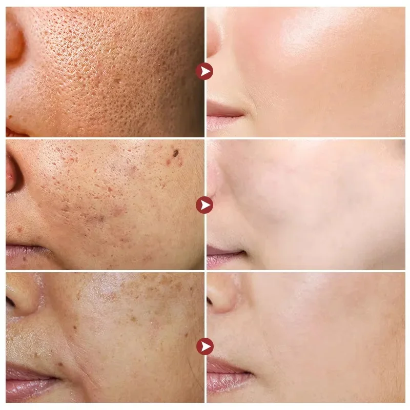 Krim Wajah anti-keriput, krim beras, perawatan jerawat Melasma pigmentasi pemutih wajah, pelembab kecantikan Korea