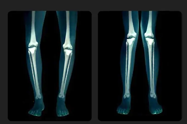 Correct xo leg orthotic o-leg leggings with bow-leg straight leg artifact leg correction