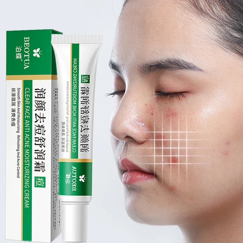 Acne Treatment Cream Face Skin Care Effective Herbal Black Dots Acne Pimple Mark Remover Anti-aging Moisturizin Whitening Cream