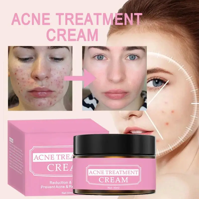 Remover acne suave reparação pits acne marcas nutrir hidratante hidratante acne creme