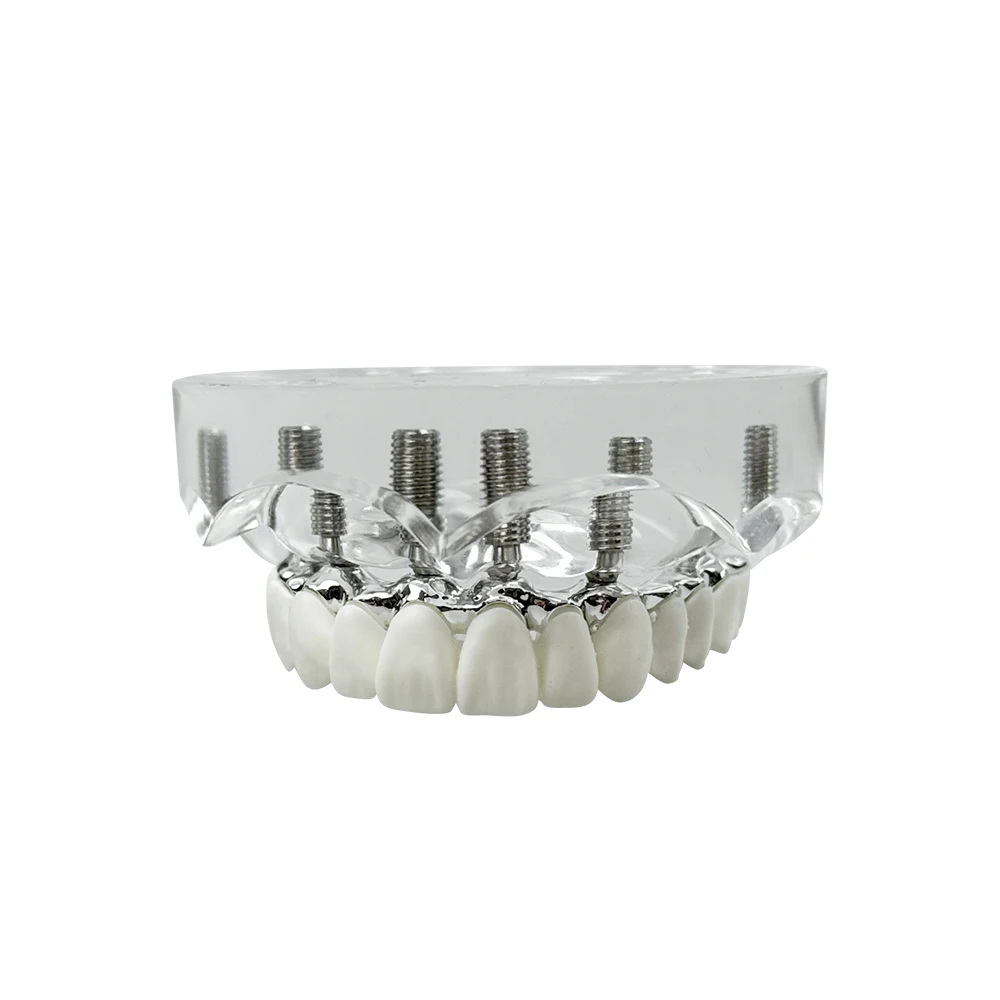 

Dental Implant Model Simulation Upper/Lower Jaw Restoration Overdenture Removable 6 Implants Screws Dental Teaching Demo Model