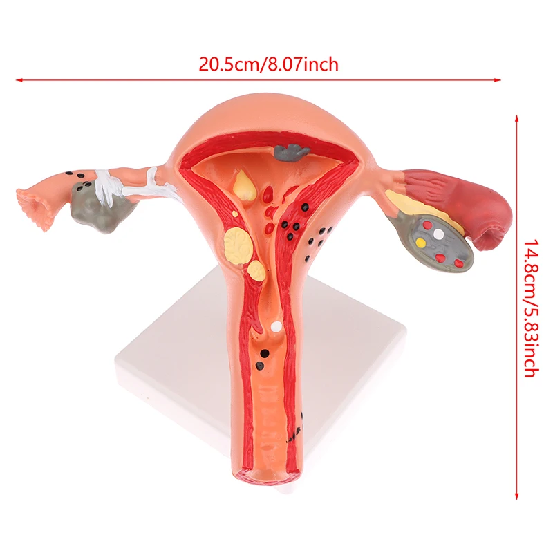 1Pcs Medical Props Model Pathological Uterus Ovary Anatomical Model Anatomy Cross Section Study Tool