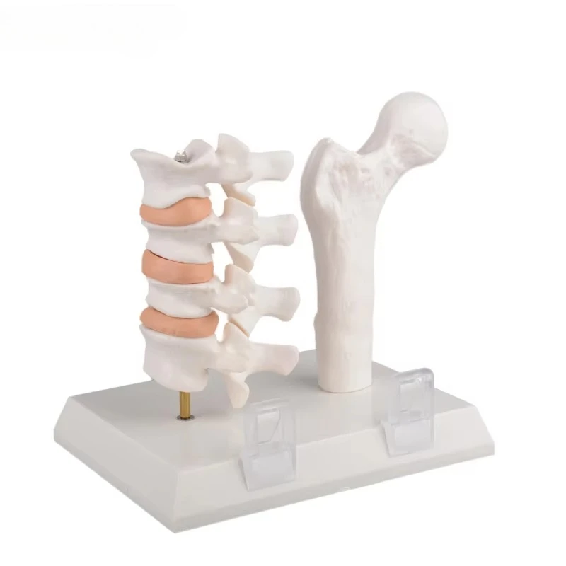 Osteoporosis Model of Femur and Lumber Bone Fracture Anatomy Model for Medical Science Classroom Education