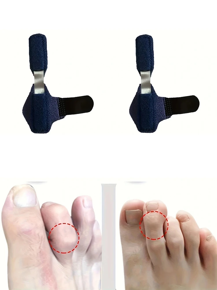 1PC Voetverzorging Teen Spalk Stijltang Vingers Klauw Stabilisator Ondersteuning Gebogen Klauw Teen Corrector Uitlijning Protector - afbeelding 2