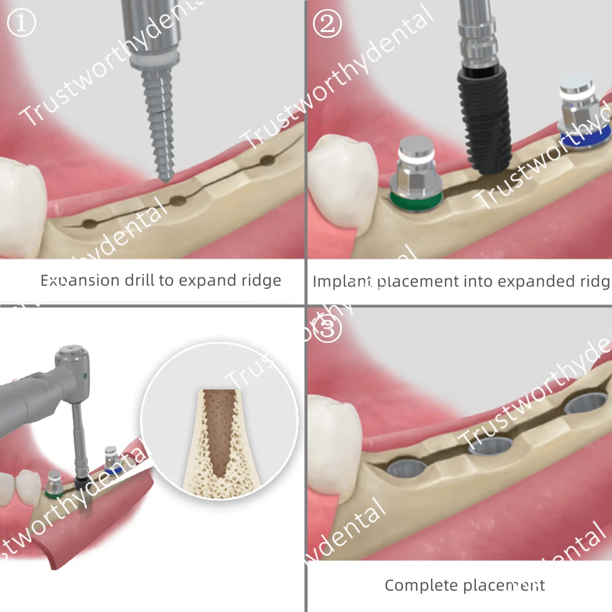 3 rozmiary rękojeści dentystycznej Wiertła do ekspansji kości Wiertła śrubowe do ekspanderów kompresyjnych