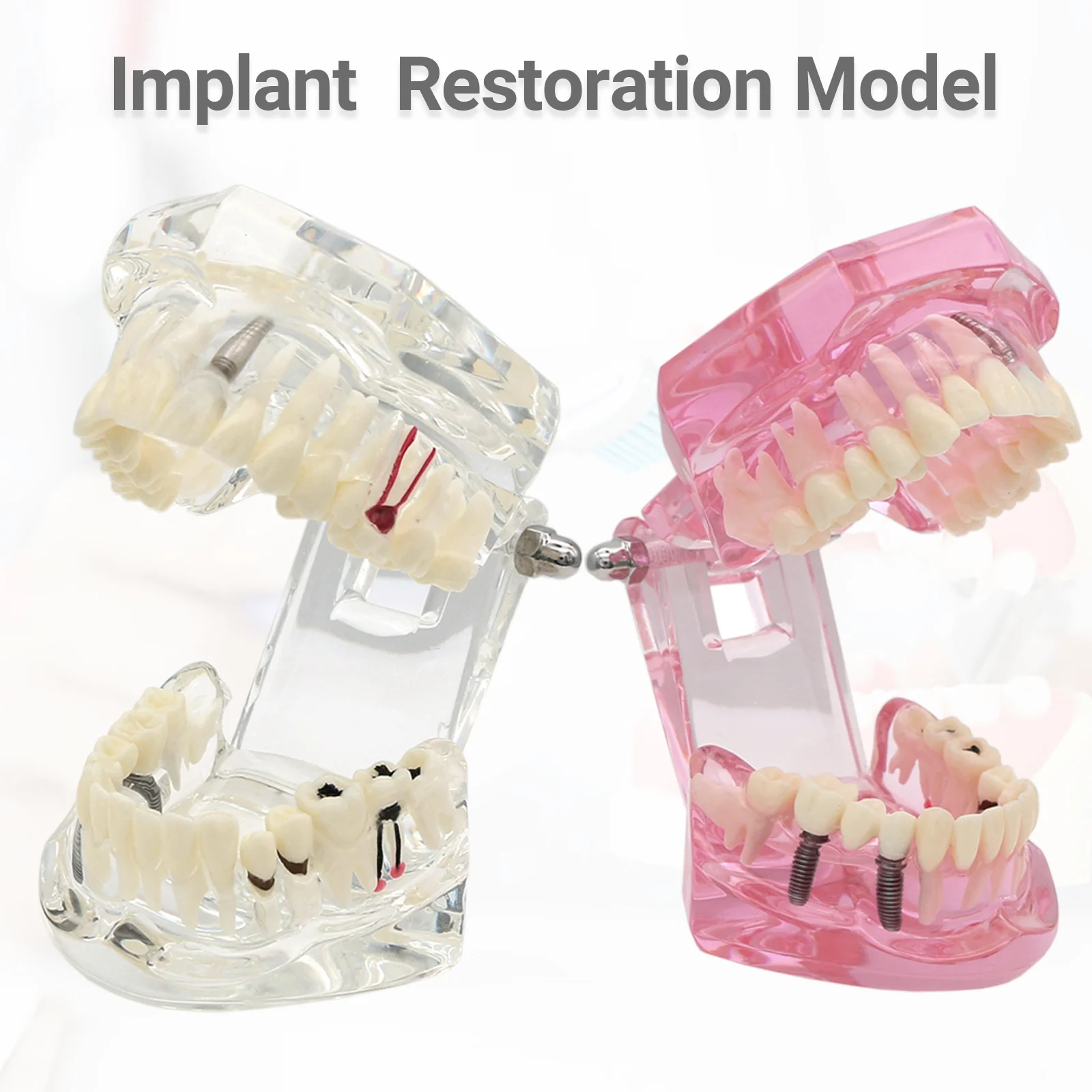 Removable Teeth Models Dental Implant And Restoration Model Dental Model Teeth Implant Restoration Bridge Teaching Demonstration
