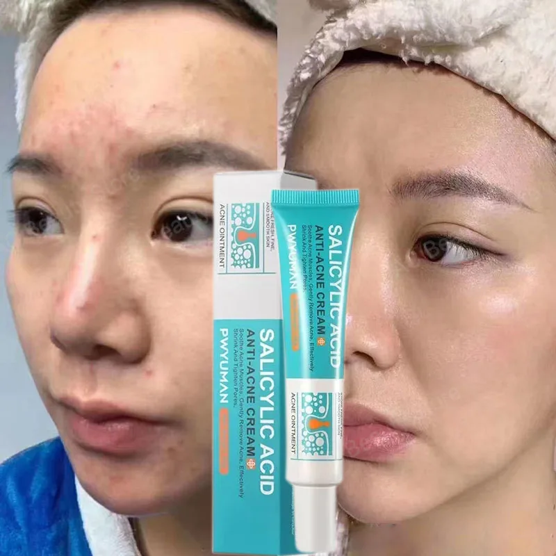 

Salicylic Acid Acne Treatment Cream Repair Pimple Spots Deep Cleaning Pore Shrinking Anti-acne Oil Control Moisturizer Skin Care