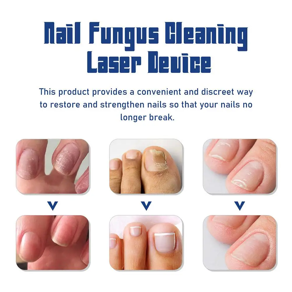 Dispositivo de tratamento a laser para fungos nas unhas, reparação de fungos nas unhas dos pés, tratamento de onicomicose, unhas a laser com relaxamento de cogumelos