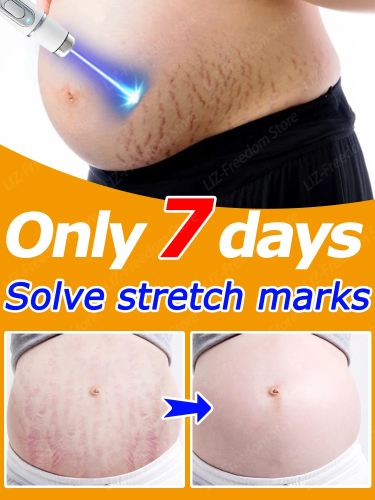 

Stretch Mark Cream Rejuvenates Skin