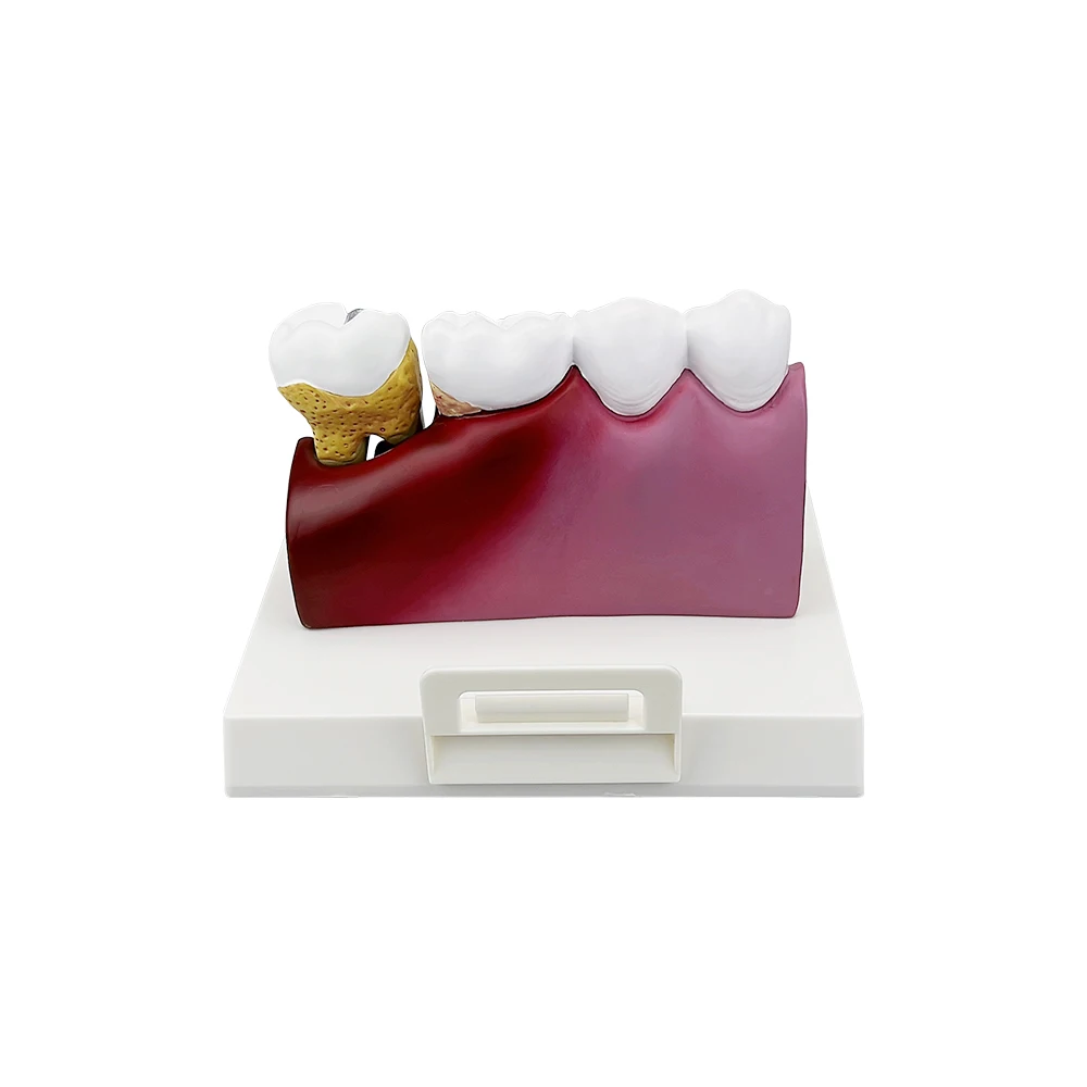 1Pcs Dental Caries Anatomy Model Comprehensive Pathology Tooth Nerve Tooth Model Oral Education Training Tooth Model