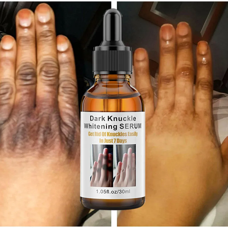 ﻿ Black Skin Remover Essence Elbows Hand Dark Knuckle Fast Brightening Serum Lightening Glow Recipe Skincare Body Products