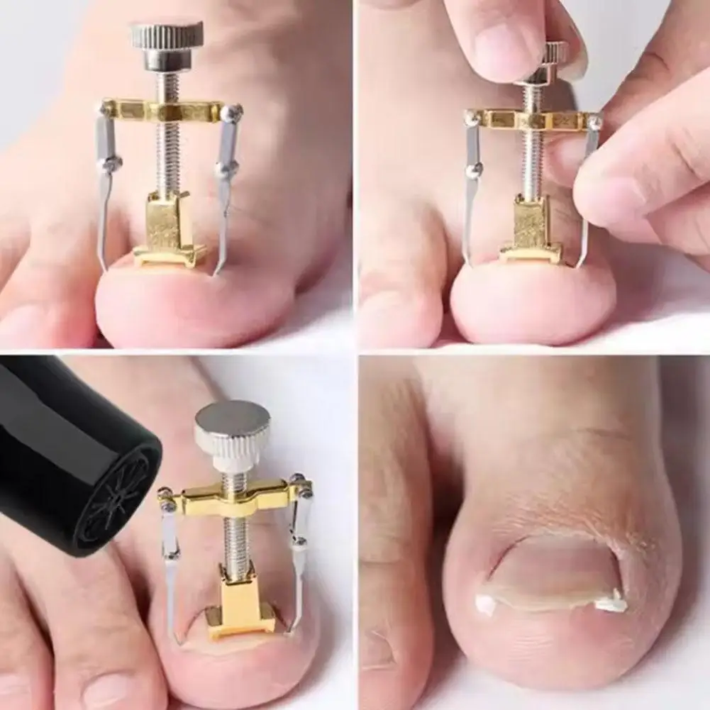 Nova ferramenta de correção de recuperação de unhas encravadas, pedicure, unha ortopédica, ferramenta de cuidados de pedicure, fixador, ferramenta corretora na x7i7