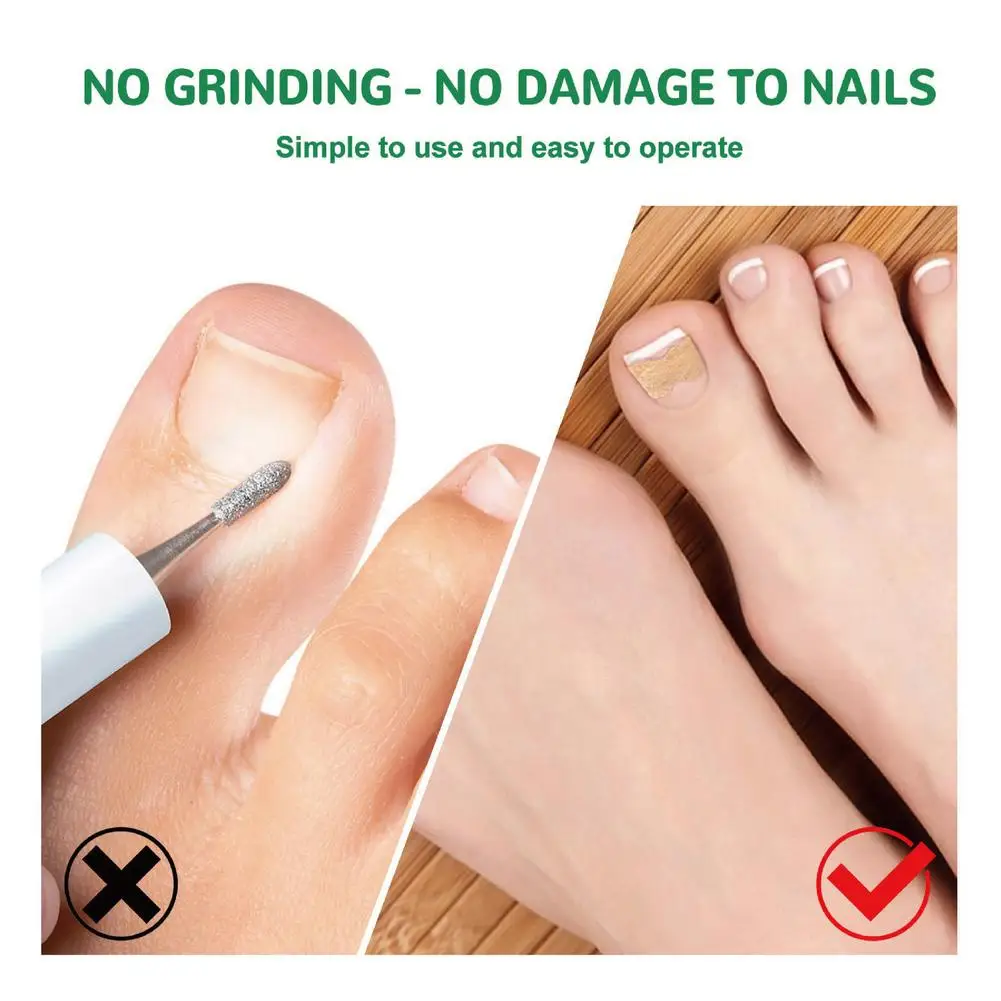 

Nail Correction Stickers Waterproof Ingrown Toenail Correction Strips Anti Infection Nail Treatment Patch Health Toe Care
