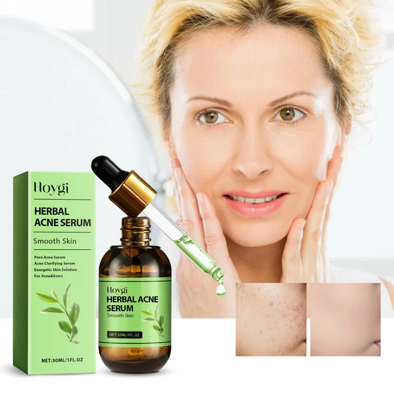 

Herbal Acne Essence For Reducing Pimples, Zits & Blackheads, Balancing Oil, Deep Moisturizing, Hydrating & Smoothing Skin