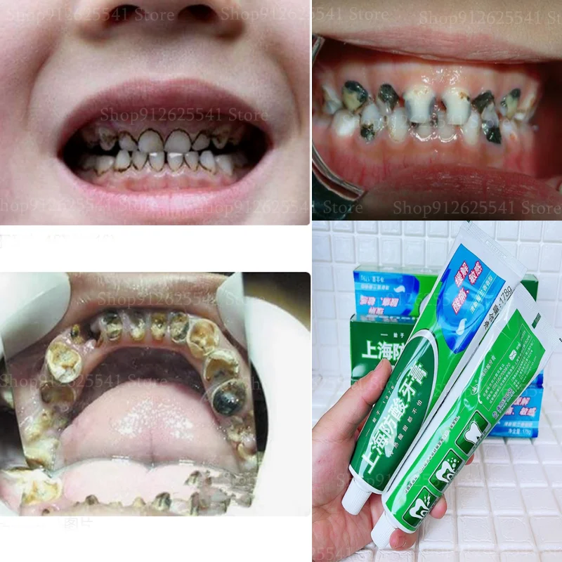 Effective Anti-acid Toothpaste for Bad Breath Treatment Cure Mouth Smell Remover Teeth Whitening Stain Remove Tartar Yellow