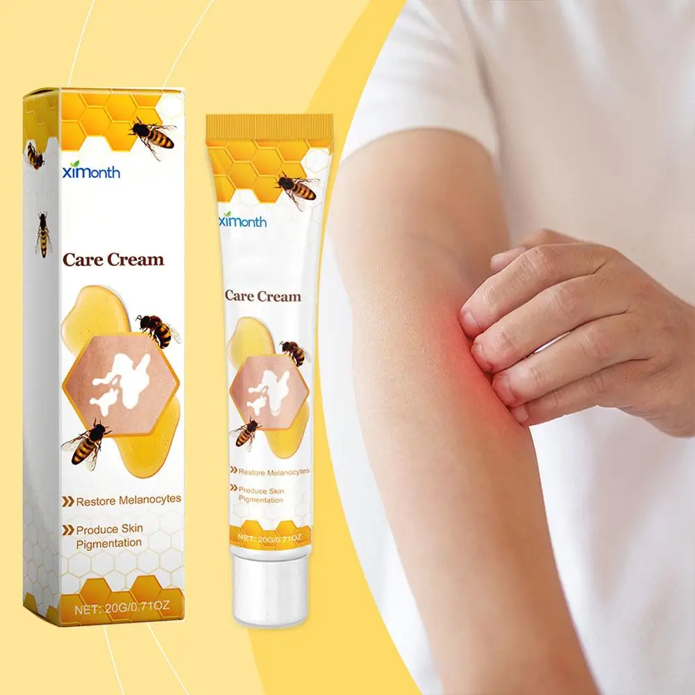 Vitiligo Tratamento Bee Cream, spray de alívio, tratamento da pele lâmpada, mancha branca remoção pomada, eliminar vitiligo