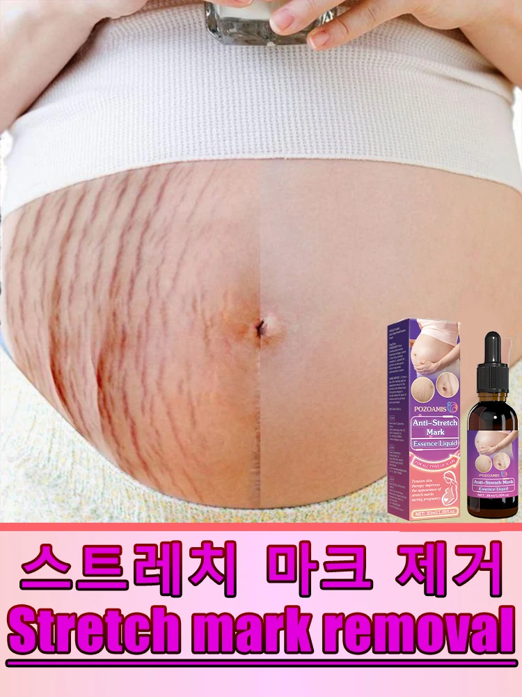Essential Stretch Mark Oil for Pregnancy and Postpartum
