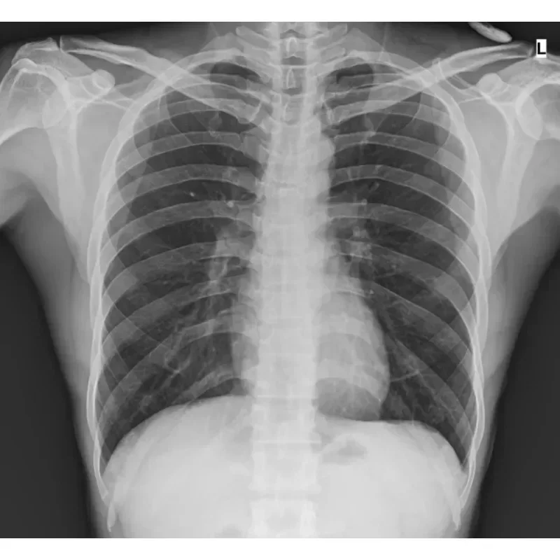 Cyfrowy przenośny aparat rentgenowski z panelem DR do radografii Diagnostyka obrazu Cyfrowy detektor rentgenowski