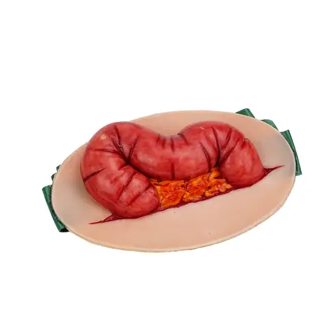 Ultrassist Wearable Abdominal Evisceration Intestinal Wound Simulator Open Abdominal Wound Packing for Wound Care Practice