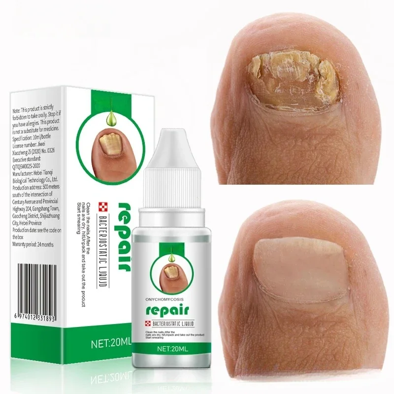 Nail Fungus Treatment Serum Toe Fungal Repair Products Hand Foot Care Removal Gel Anti Infection Onychomycosis Paronychia