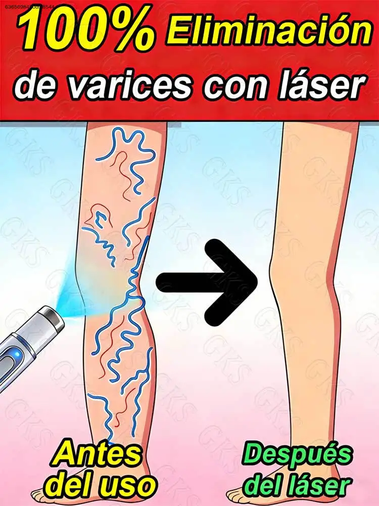 

Blue light pen, relieves leg problems, improves spider legs within 7 days.