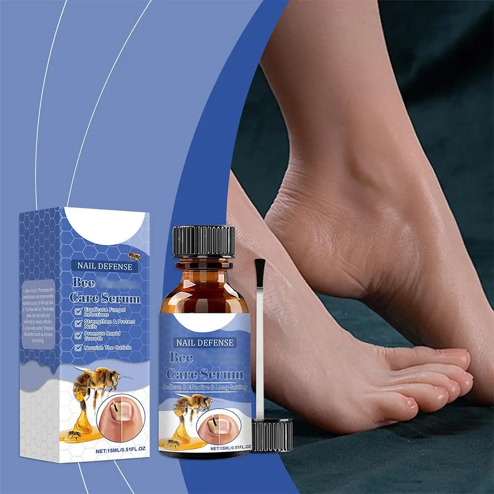 خلاصة العناية بفطر onycosis لسم النحل للأظافر والأظافر السميكة وأصابع القدم ، إصلاح سريع ، علاج ، العناية بالقدم ، 15 فطر