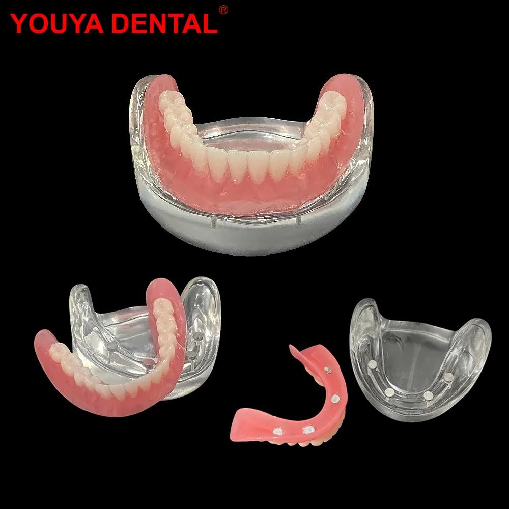 Mandibular Dental Model Teeth Implant Restoration Models Removable Bridge Dentistry Lower Jaw Overdenture For Teaching Studying